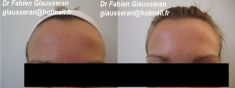 Dr Fabien Giausseran - Cliché avant - Dr Fabien Giausseran