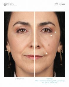 Traitement galvanique (Nu Skin Galvanic spa system ™ )  – revitalisation de la peau - Cliché avant
