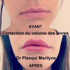 Augmentation des lèvres (acide hyaluronique) - Injection d