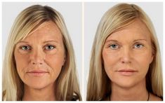 Mésothérapie, regénération du visage et du cou - Cliché avant - Dr Franck Benhamou
