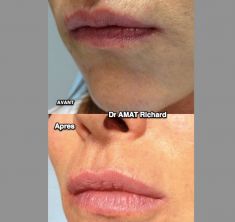 Augmentation des lèvres - Cliché avant - Dr Richard Amat Centre de Micro-greffe de cheveux FUE