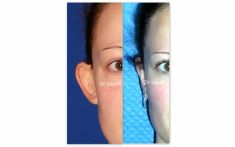 Otoplastie (Chirurgie esthétique des oreilles) - Cliché avant - Dr Adel Louafi
