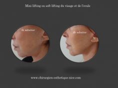 Mini lifting (lifting cervico-facial) - dès les premiers signes de vieillissement le mini-lifting permet de les corriger et de conserver un visage en pleine forme naturellement!