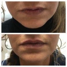 Augmentation des lèvres (injection de graisse) - Cliché avant - Dr Emmanuel Elard