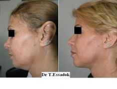 Chirurgie du double-menton - Cliché avant - Dr Tayeb Essadok