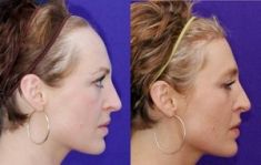 Greffe de cheveux - Pas de cicatrices: la technique rend la procédure quasi invisible aux autres.