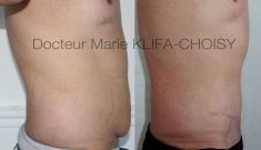 Abdominoplastie - Cliché avant - Dr Marie Klifa-Choisy