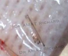Greffe de cheveux - Cliché avant - Dr Richard Amat Centre de Micro-greffe de cheveux FUE