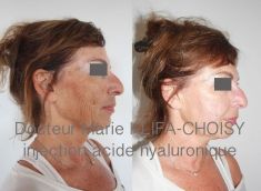 Dr Marie Klifa-Choisy - http://www.chirurgie-esthetique-nice.fr/medecine-esthetique/injections/injections-acide-hyaluronique/