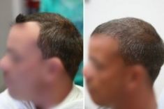 Greffe de cheveux - Cliché avant - Dr. Paul Benet