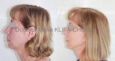 Dr Marie Klifa-Choisy - http://www.chirurgie-esthetique-nice.fr/chirurgie-esthetique/chirurgie-du-visage/liftings-du-visage/
