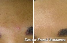 Traitement acné - laser - Cliché avant - Dr Franck Benhamou