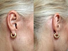 Lifting du visage - Cicatrices devant et derrière l’oreille
