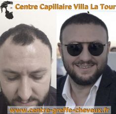 Greffe de cheveux - Cliché avant - Centre Capillaire Villa La Tour