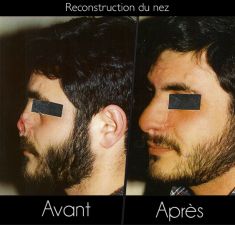 Chirurgie réparatrice du visage - Cliché avant - Dr Alice de Taddeo
