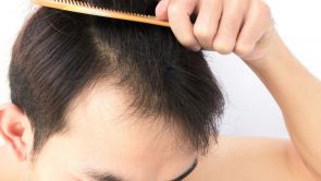 Greffe de cheveux (Implants capillaires)