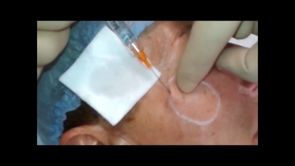 Dr Eric BONAFOS traitement pour redonner du volume au joues et pommettes