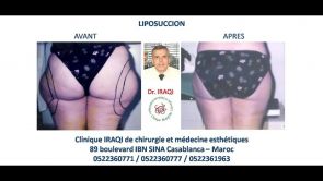Liposuction Morocco, Dr. Kamal Iraqi Houssaini