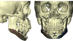 Nouvelles technologies pour la chirurgie du contour facial ; génioplastie, ostéotomie de chin wing et prothèses d’angles mandibulaires.