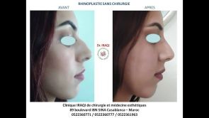 Rhinoplastie - Chirurgie esthétique du nez Maroc - Rhinoplasty Morocco