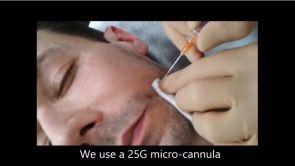 Dr Eric BONAFOS traitement des sillons naso geniens par ac hyaluronique avec micro canule