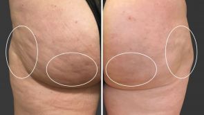 Cellfina - Traitement de la cellulite