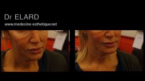 Restauration de l'ovale du visage et comblement des joues creuses