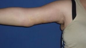 Lifting des bras ou brachioplastie