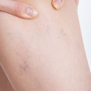 Veines violettes Varicosités jambes traitements - Suppression des ...