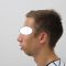 Chirurgie du double-menton
