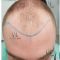 Greffe de cheveux