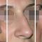 Rhinoplastie