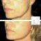 Mini lifting (lifting cervico-facial)