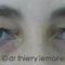 Blépharoplastie