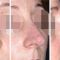 Rhinoplastie