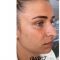 Rhinoplastie médicale