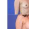 Augmentation mammaire (Implants mammaires)