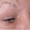 Blépharoplastie