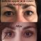 Blépharoplastie