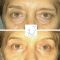 Blépharoplastie inférieure
