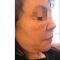 Lifting facial par fils tenseurs - PDO