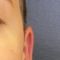 Otoplastie (Chirurgie esthétique des oreilles)