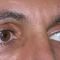 Blépharoplastie