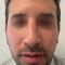 Rhinoplastie
