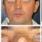 Septoplastie (opération de la cloison nasale)