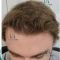 Greffe de cheveux
