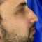 Rhinoplastie