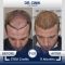 Greffe de cheveux