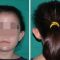 Otoplastie (Chirurgie esthétique des oreilles)