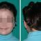Otoplastie (Chirurgie esthétique des oreilles)